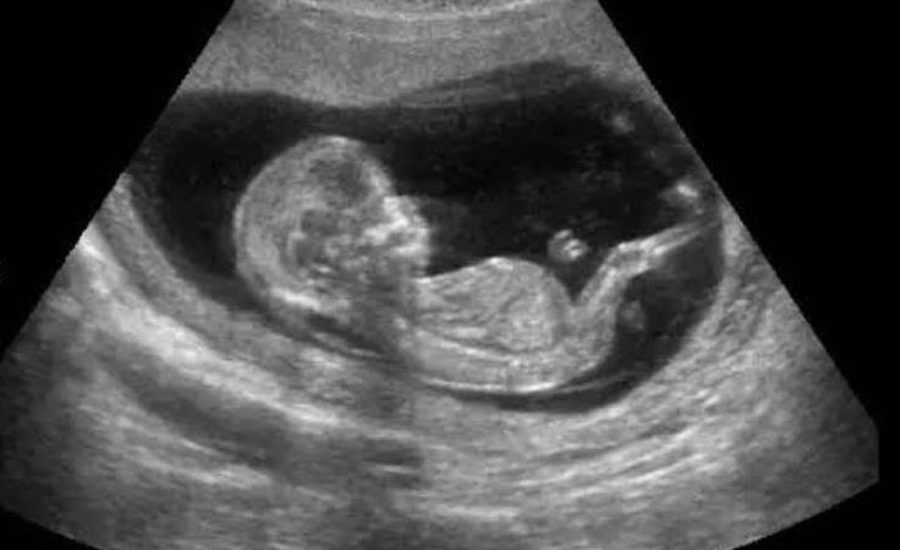 Imagen de ecografía morfológica y genética del bebé - Centro Médico Arisana