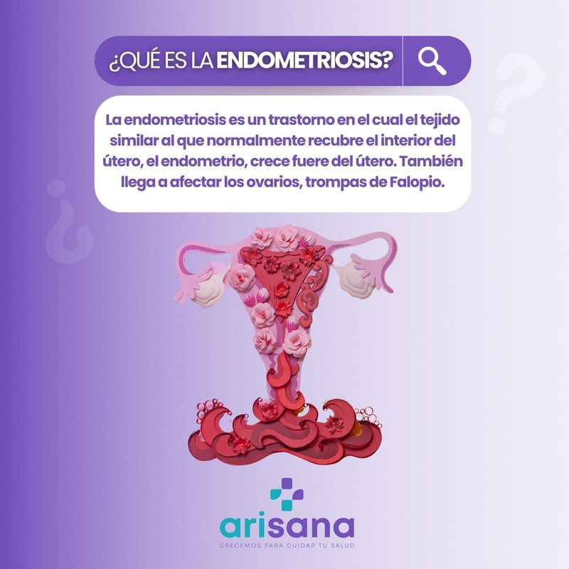 Infografía explicando qué es la endometriosis - Blog de salud Arisana