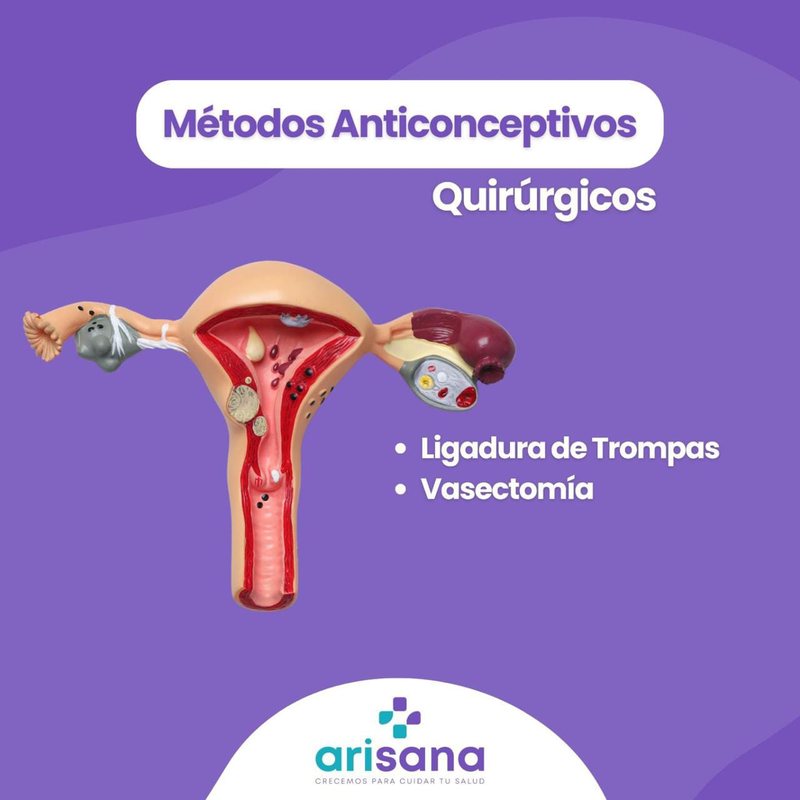 Infografía de métodos anticonceptivos quirúrgicos - Arisana